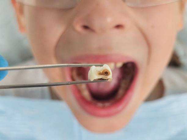 Best Emergency Dental Filling Replacement  in Wilmore, KY